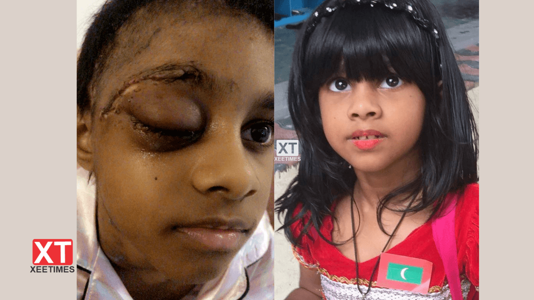ލުހާ: ނުރައްކާތެރި ޓިއުމަރާއެކު ކެންސަރު ޖެހި 1 ލޮލުގެ ފެނުން ގެއްލި އެދެނީ ފަރުވާއަށް އެހީއަށް!