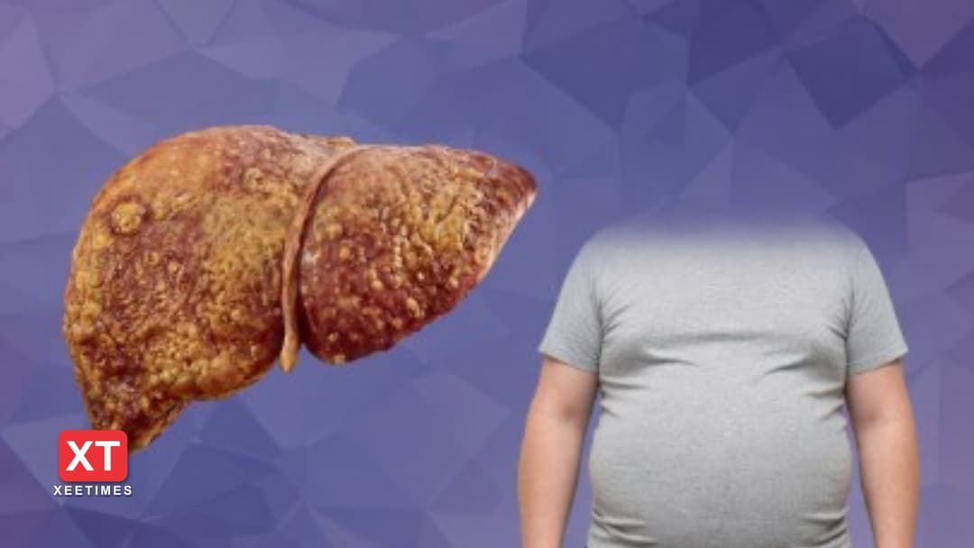 ފެޓީ ލިވަރ: ހަނދާން ނައްތާލެވިފައިވާ މި ގުނަވަނުގެ ސިއްރު ބަލިމަޑުކަން